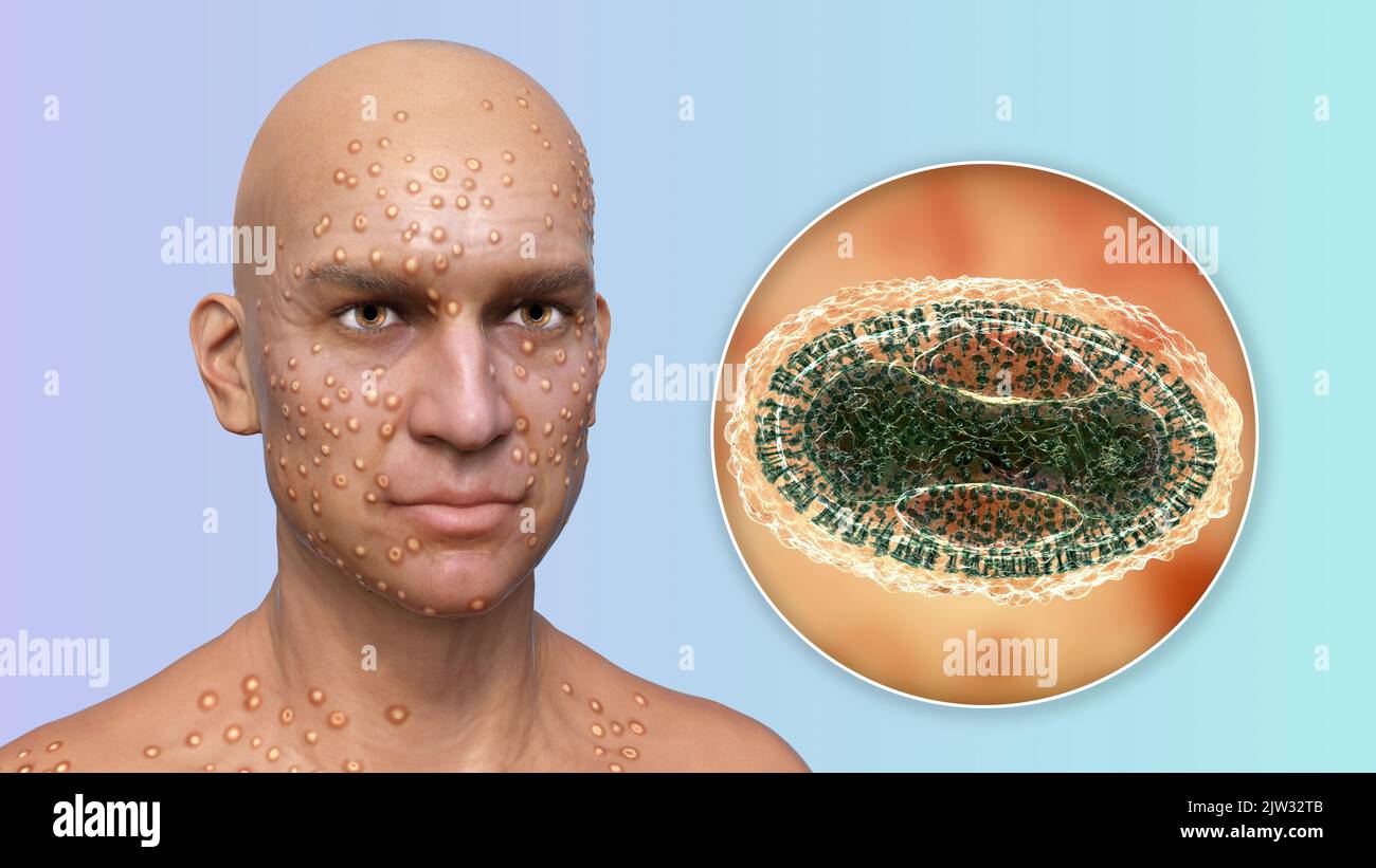 Paziente con vaiolo (variola) e primo piano di un virus del vaiolo, illustrazione. Il vaiolo è una malattia che causa febbre e spesso la morte. È stato sradicato dopo uno sforzo mondiale negli anni '1970s, ma esistono ceppi nei laboratori di ricerca. Lesioni cutanee simili si possono trovare nei virus attualmente disponibili della famiglia Poxviridae, come il monkeypox, che hanno anche la stessa morfologia del virione. Foto Stock