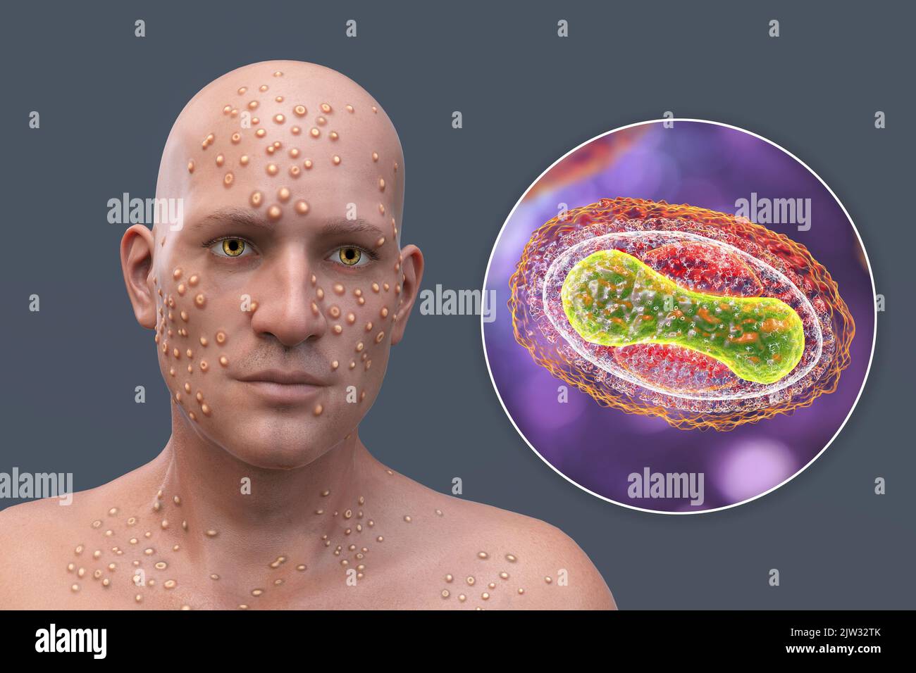 Paziente con vaiolo (variola) e primo piano di un virus del vaiolo, illustrazione. Il vaiolo è una malattia che causa febbre e spesso la morte. È stato sradicato dopo uno sforzo mondiale negli anni '1970s, ma esistono ceppi nei laboratori di ricerca. Lesioni cutanee simili si possono trovare nei virus attualmente disponibili della famiglia Poxviridae, come il monkeypox, che hanno anche la stessa morfologia del virione. Foto Stock