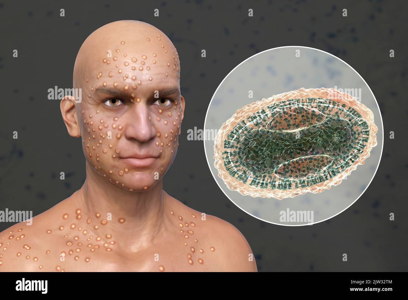 Paziente con vaiolo (variola) e primo piano di un virus del vaiolo, illustrazione. Il vaiolo è una malattia che causa febbre e spesso la morte. È stato sradicato dopo uno sforzo mondiale negli anni '1970s, ma esistono ceppi nei laboratori di ricerca. Lesioni cutanee simili si possono trovare nei virus attualmente disponibili della famiglia Poxviridae, come il monkeypox, che hanno anche la stessa morfologia del virione. Foto Stock