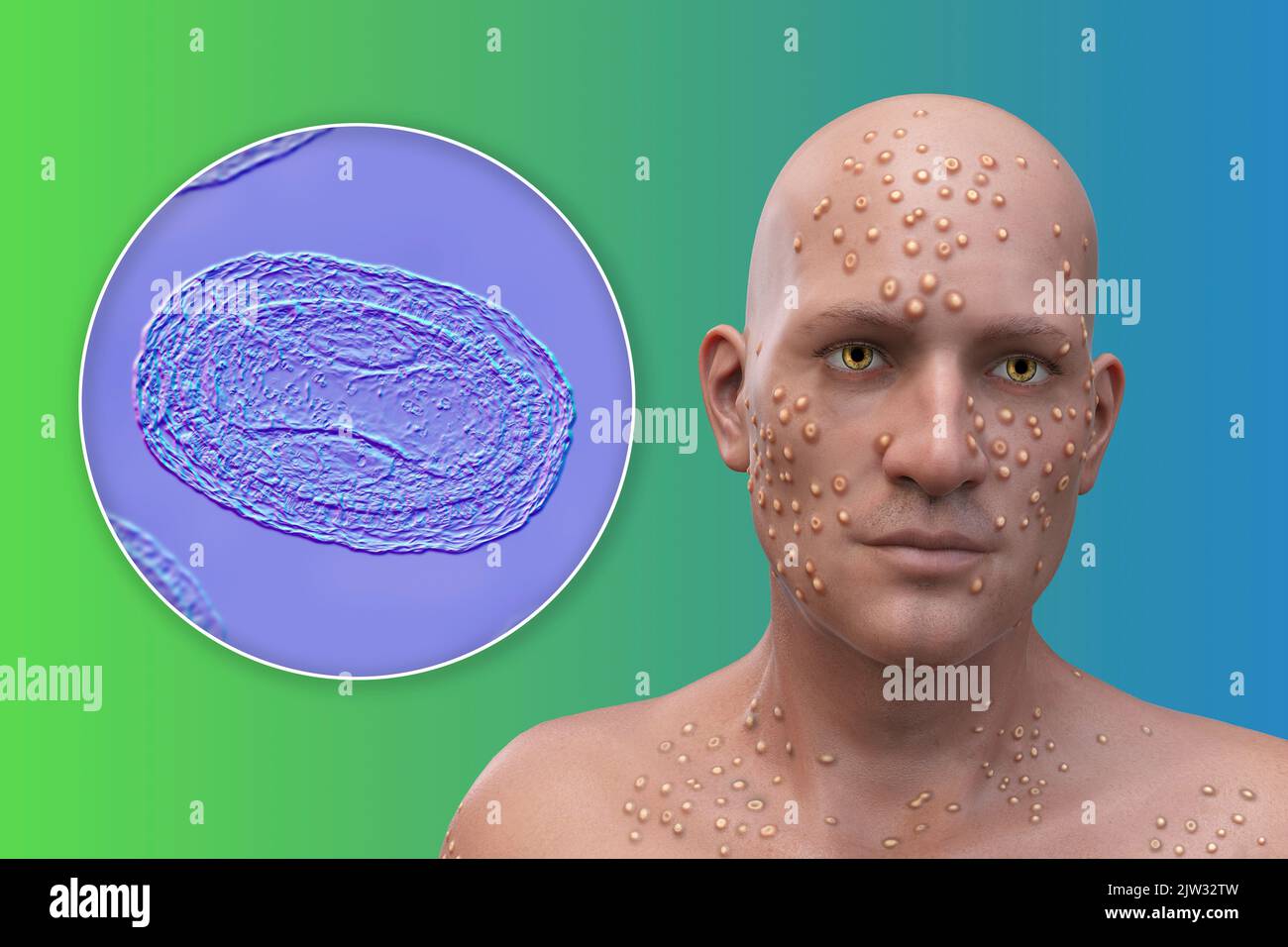 Paziente con vaiolo (variola) e primo piano di un virus del vaiolo, illustrazione. Il vaiolo è una malattia che causa febbre e spesso la morte. È stato sradicato dopo uno sforzo mondiale negli anni '1970s, ma esistono ceppi nei laboratori di ricerca. Lesioni cutanee simili si possono trovare nei virus attualmente disponibili della famiglia Poxviridae, come il monkeypox, che hanno anche la stessa morfologia del virione. Foto Stock
