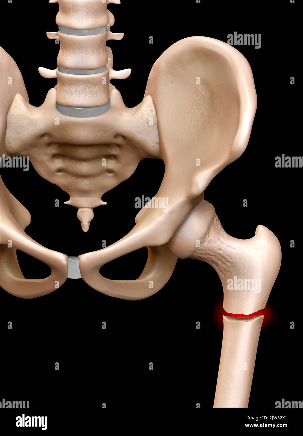 Immagine che mostra una frattura nel collo del femore (osso della coscia). Foto Stock