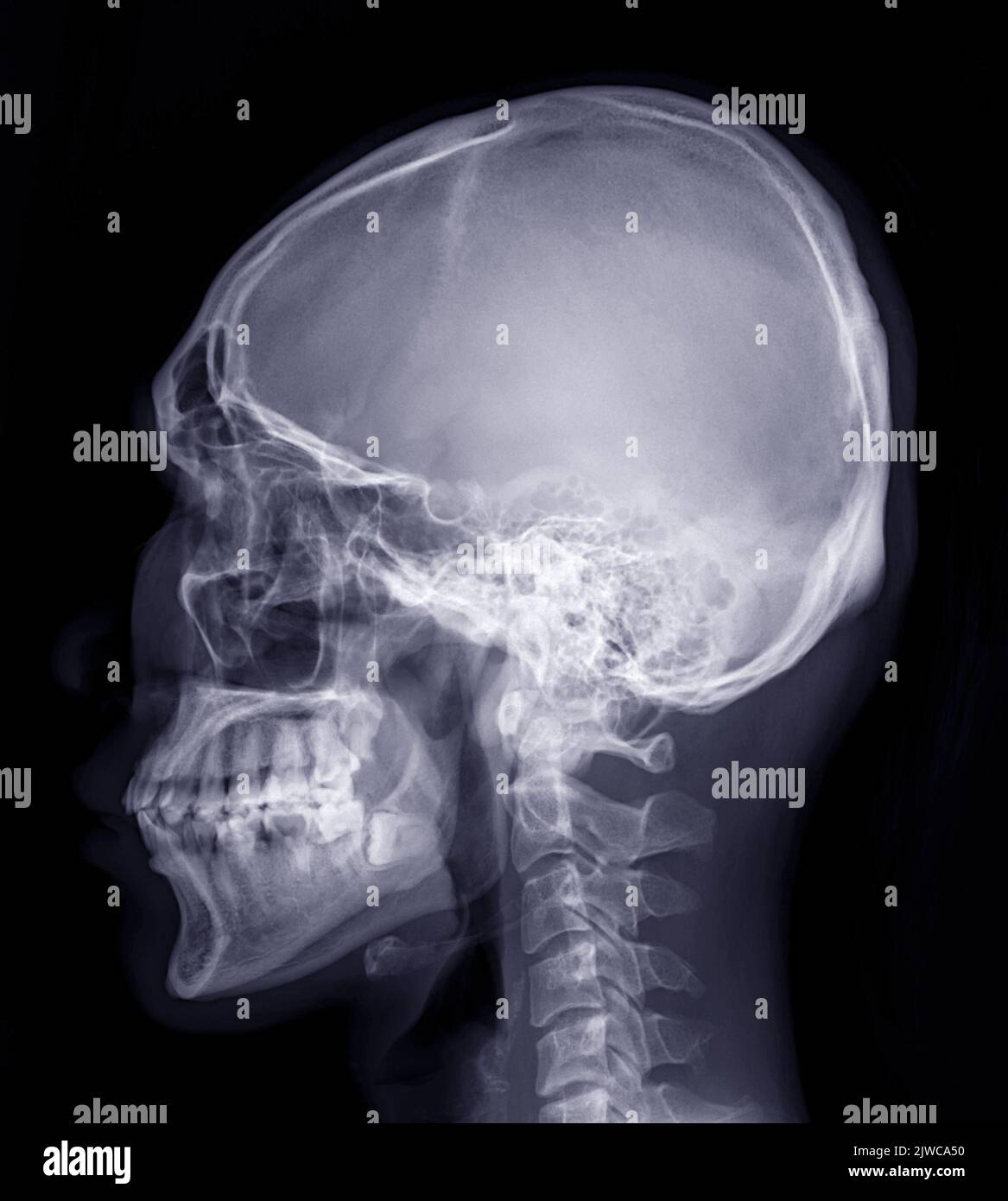 L'immagine radiografica del cranio di nome umano è la vista laterale del cranio isolata su sfondo nero. Foto Stock