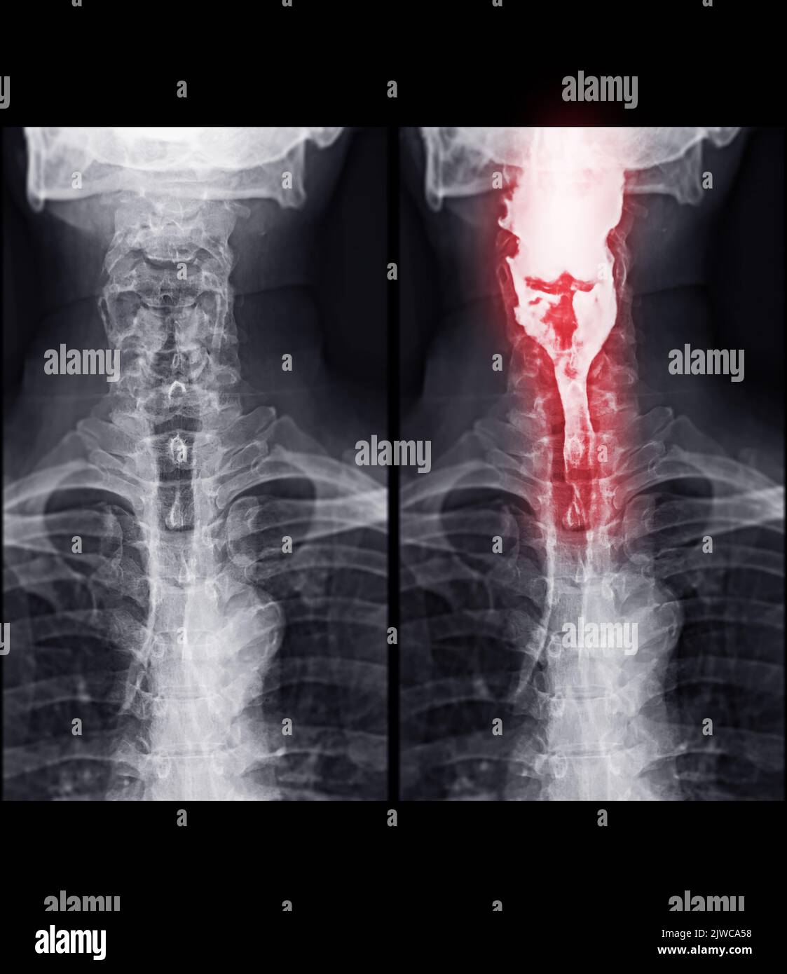 Bario Swallow test di studio diagnosticare Barrett tratto GI esame GERD ulcere serie difficoltà faringe procedura UGI gola intestinale terapia con fluoroscopia dev Foto Stock
