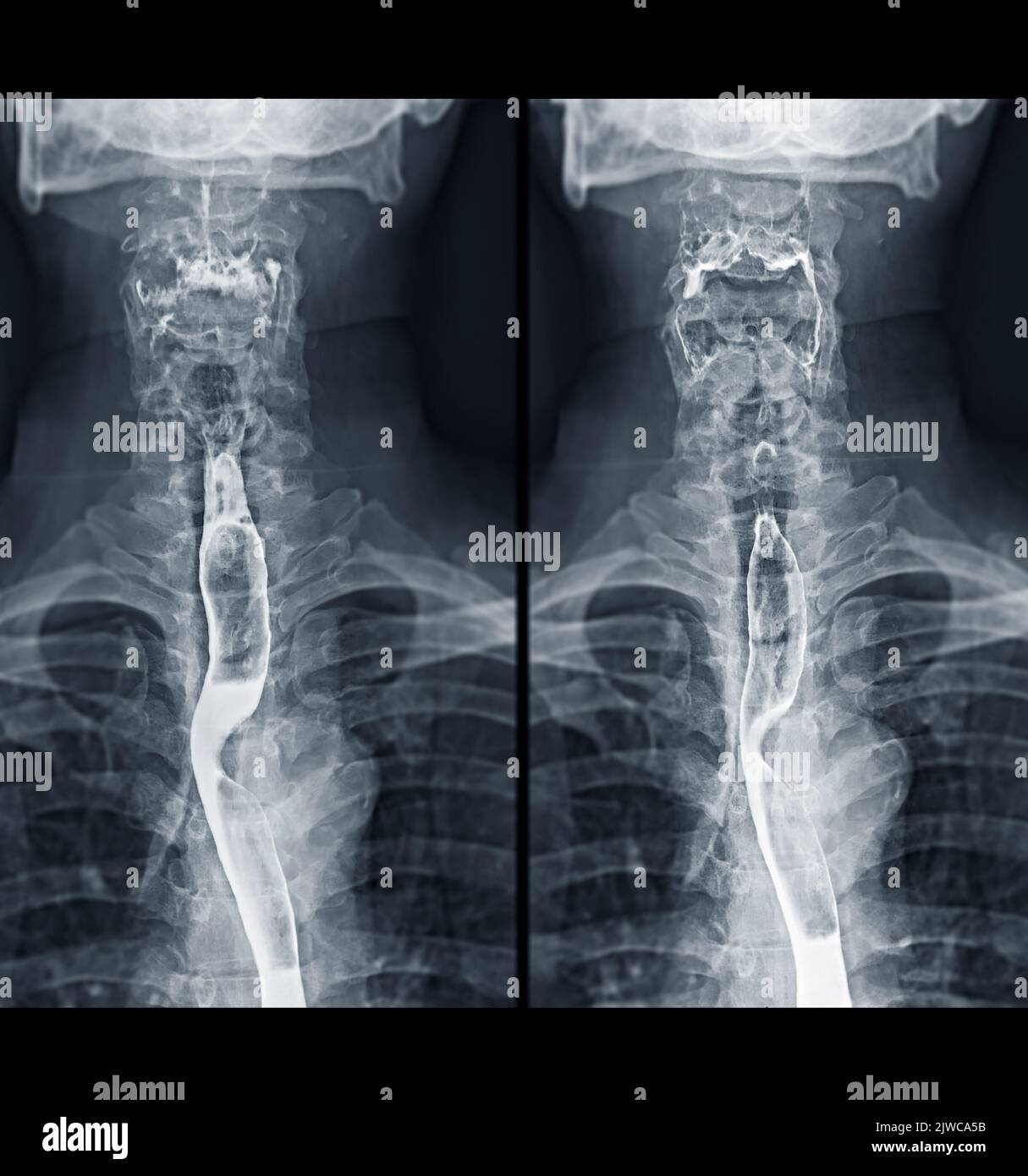 Bario Swallow test di studio diagnosticare Barrett tratto GI esame GERD ulcere serie difficoltà faringe procedura UGI gola intestinale terapia con fluoroscopia dev Foto Stock
