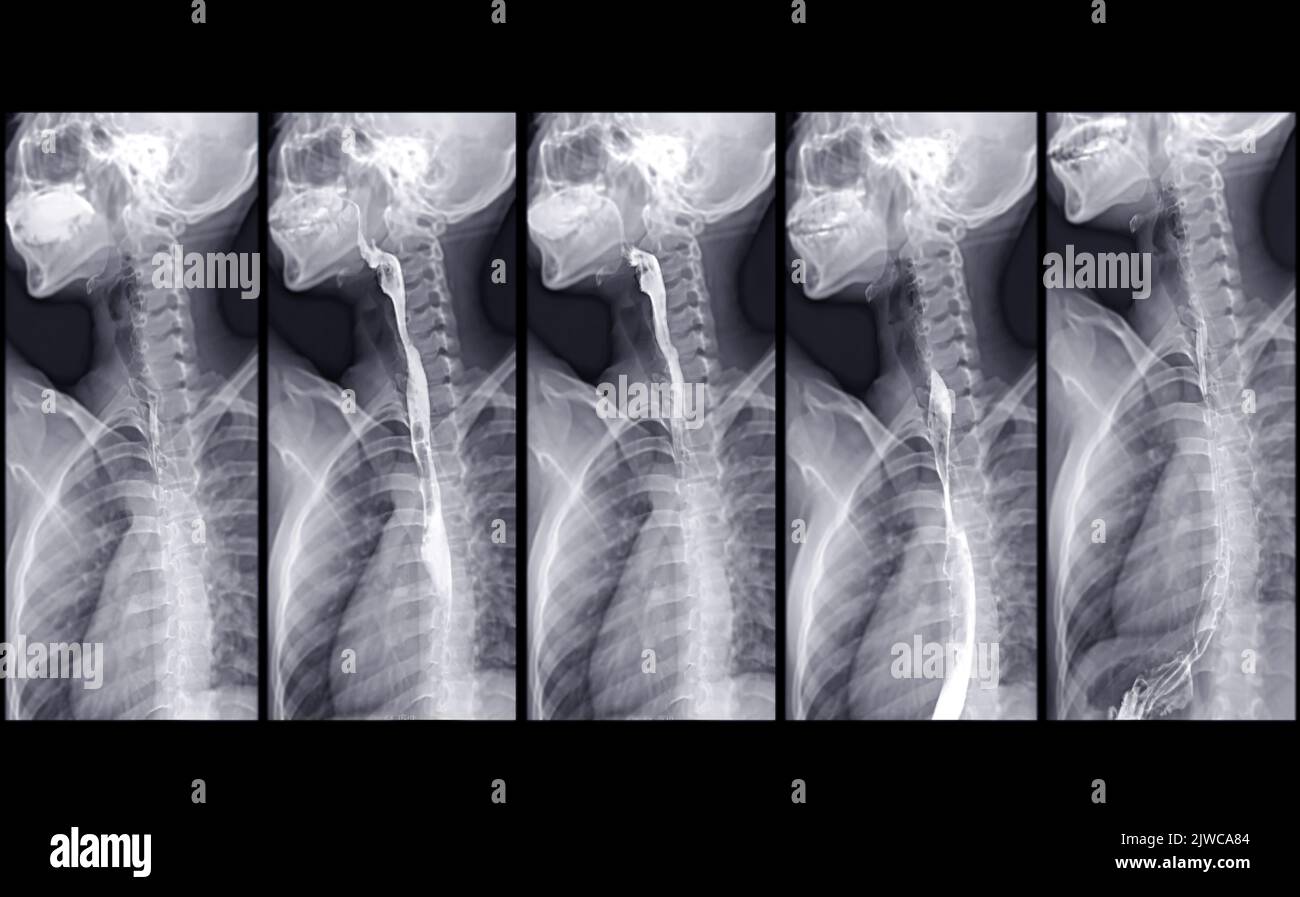 Bario Swallow test di studio diagnosticare Barrett tratto GI esame GERD ulcere serie difficoltà faringe procedura UGI gola intestinale terapia con fluoroscopia dev Foto Stock