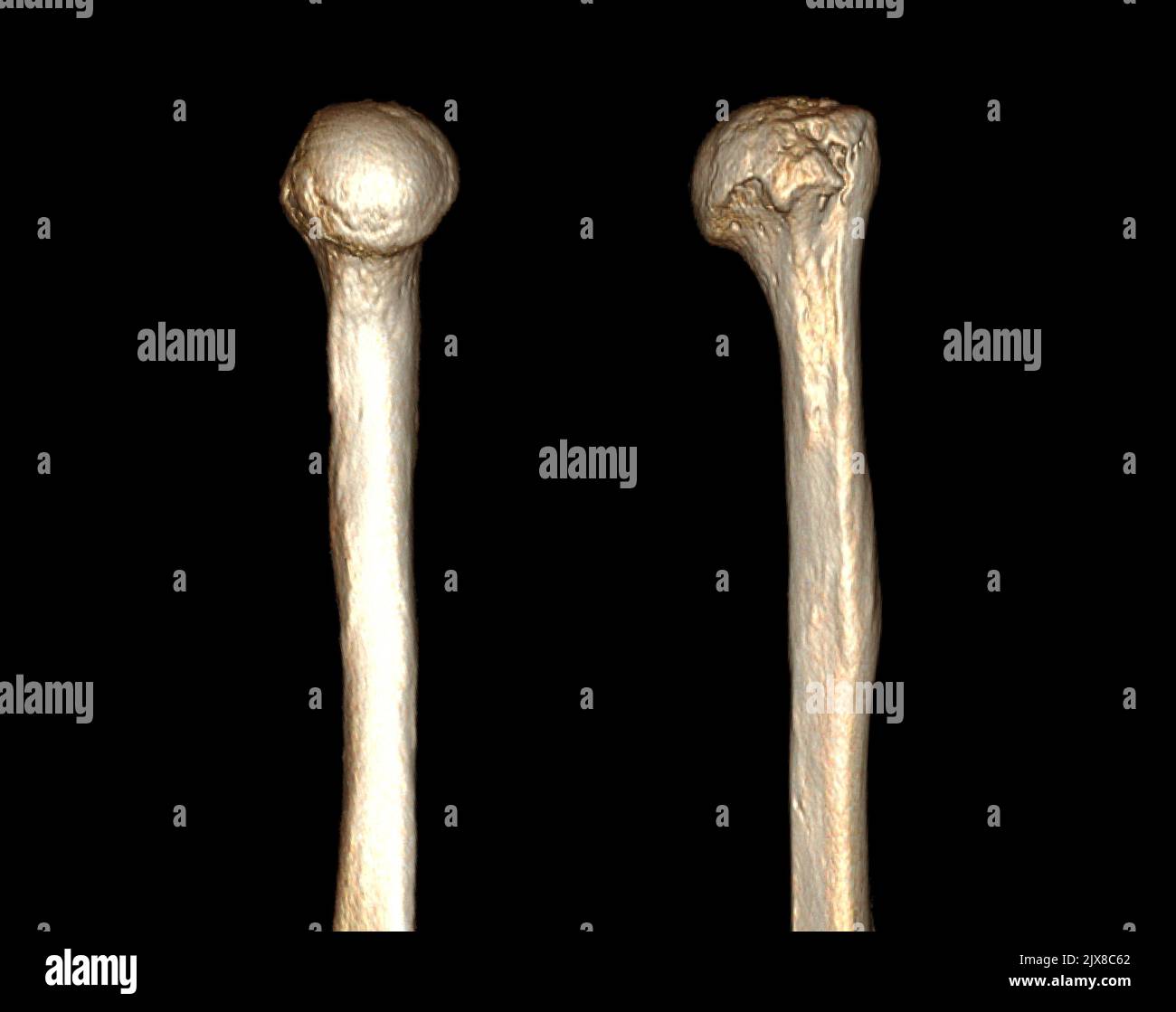 Tomografia computerizzata Volume rendering esame dell'articolazione della spalla e dell'osso omerico 3D rendering in frattura del paziente articolazione della spalla e omero bo Foto Stock