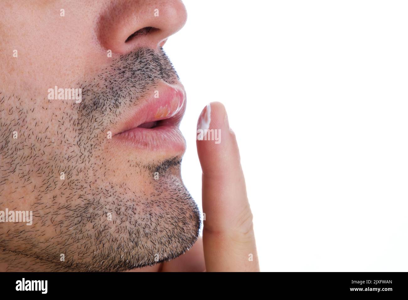 applicazione della crema per il trattamento medico delle piaghe fredde in bocca di un uomo Foto Stock