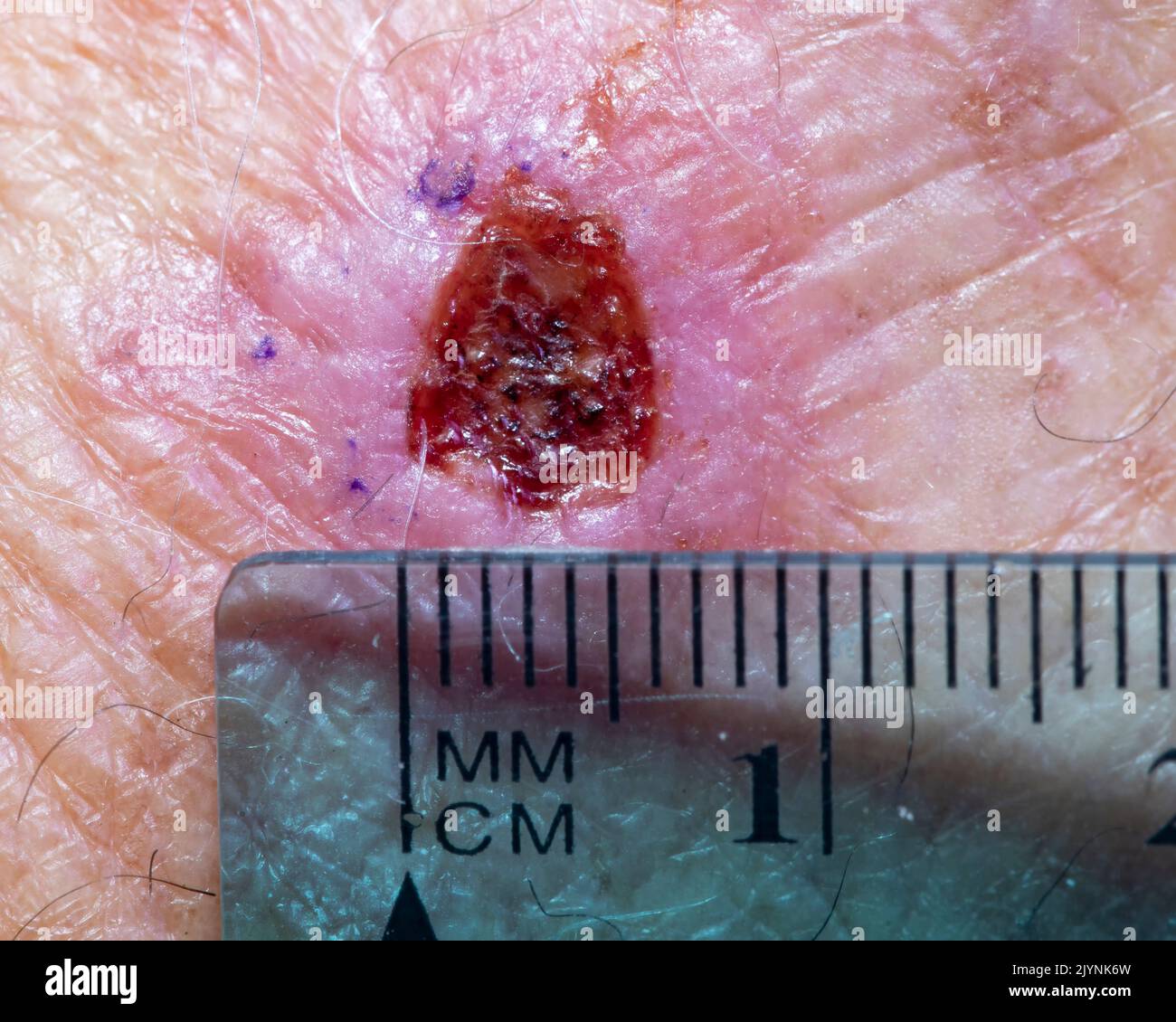 Sito bioptico incisionale del cancro della pelle sul retro di una mano maschile. Foto Stock