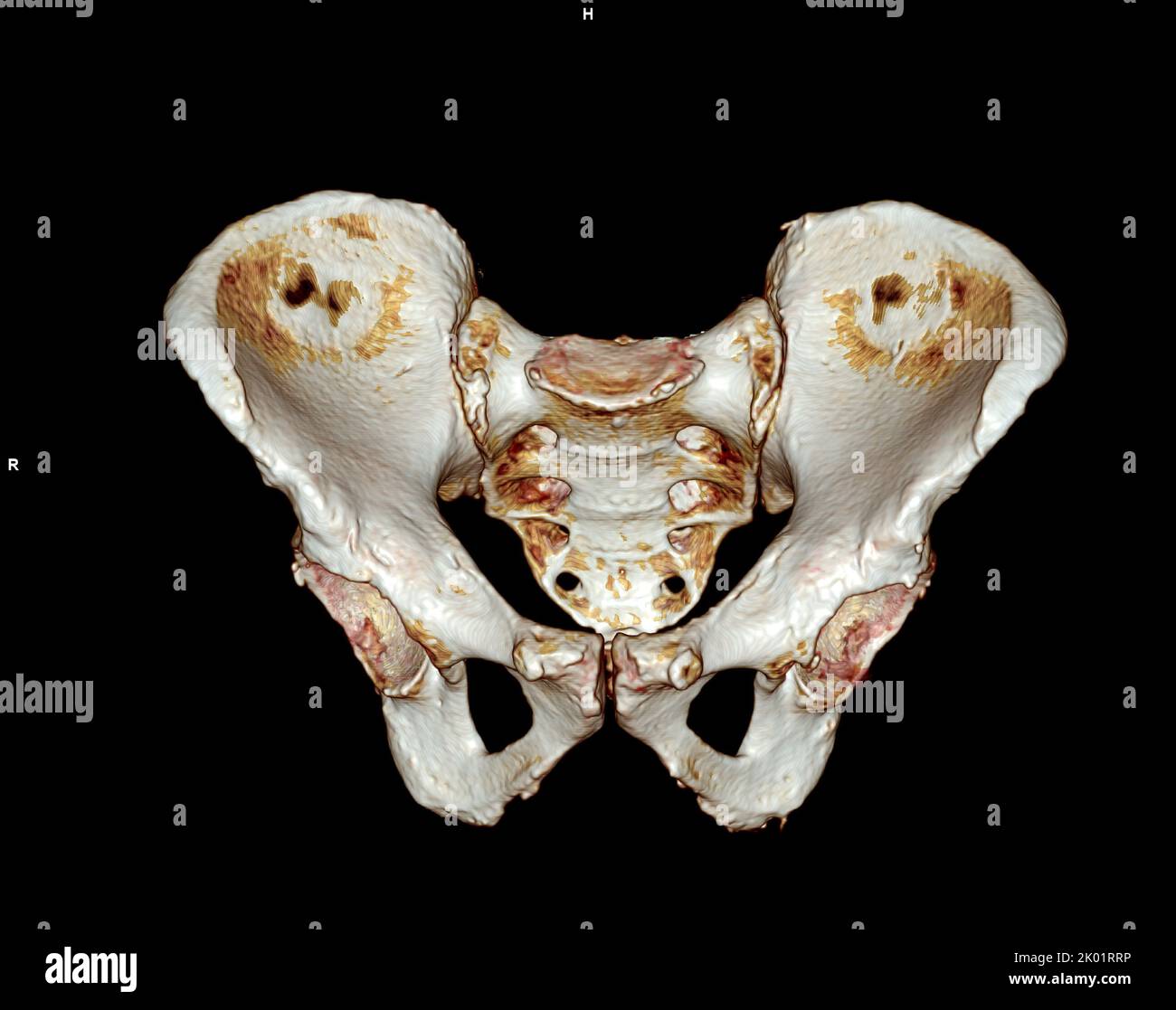 Scansione TC dell'osso pelvico e dell'articolazione dell'anca 3D per diagnosi frattura dell'osso pelvico e dell'articolazione dell'anca isolata su sfondo bianco. Foto Stock