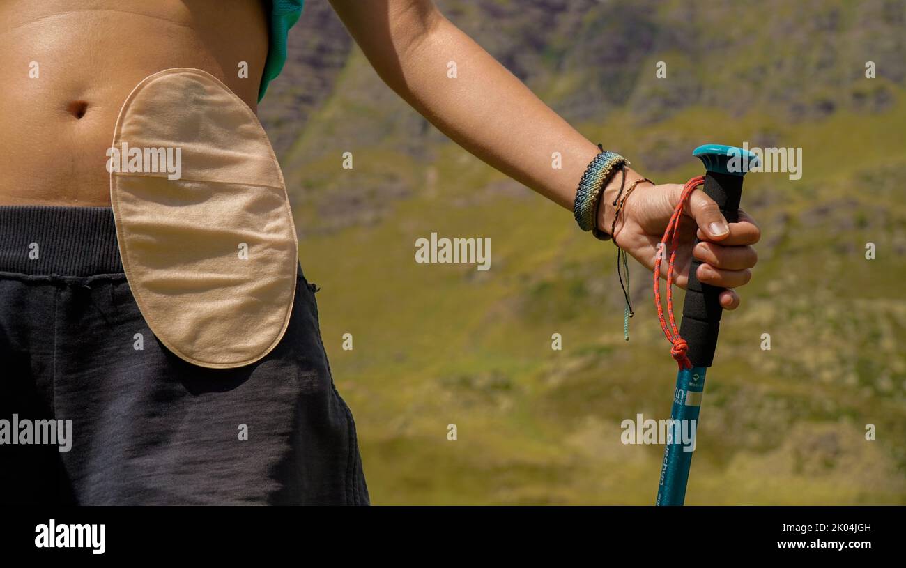 Ragazza con sacco colostomia in montagna. Foto Stock