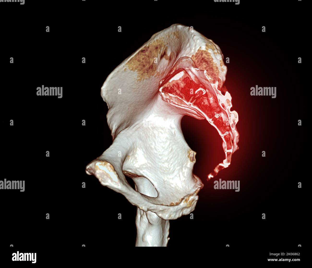 Scansione TC di coccige e osso pelvico 3D rendering per diagnosi frattura di osso coccige isolato su sfondo nero. Foto Stock