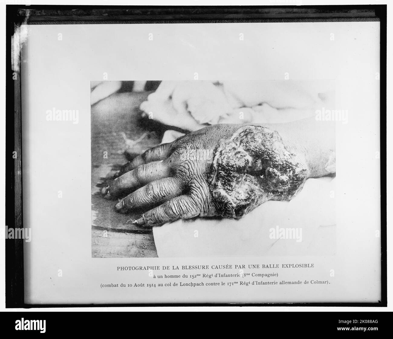Photographie de la blessure caus&#xe9;e par une balle esplosive..., 1914. '...&#xe0; un homme du 152me R&#xe9;gt. d'infanterie (8me compagnie); (Combat du 10 Ao&#xfb;t 1914 au col de Lonchpach contre le 171me R&#xe9;gt. d'infanterie allemande de Colmar). Prima guerra mondiale infortunio: Fotografia della ferita causata da un proiettile esploso ad un uomo del reggimento di fanteria 152nd (US) (8th Società); lotta del 10 agosto 1914 sulla collina di Lonchpach (in Alsazia) contro la fanteria tedesca Colmar 171st. Foto Stock