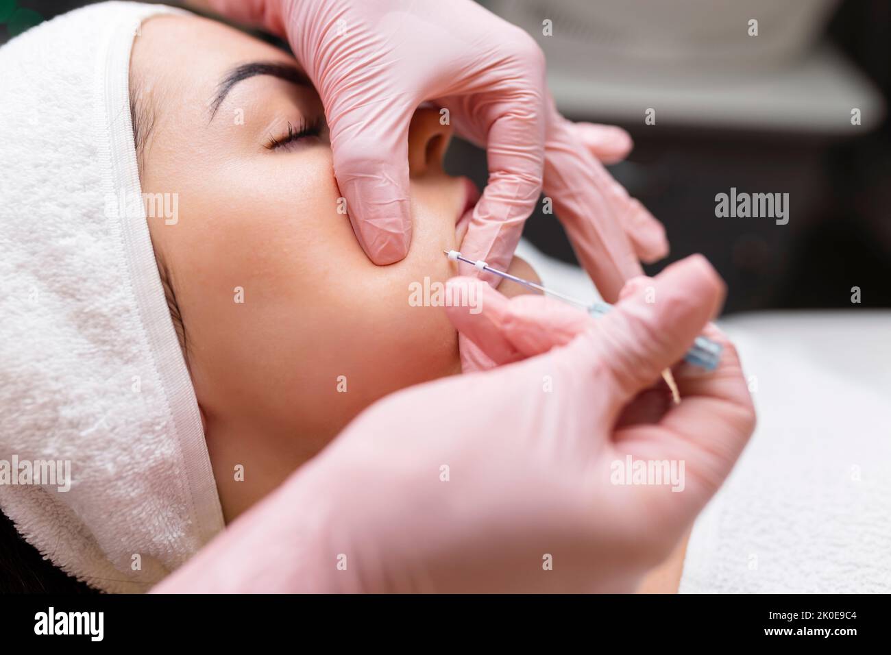 Face Lifting PDO suture Operation. Tecnica innovativa di New thread lift, cosmetologist preparandosi a fare la procedura per il cliente femminile, selezionare il Foto Stock