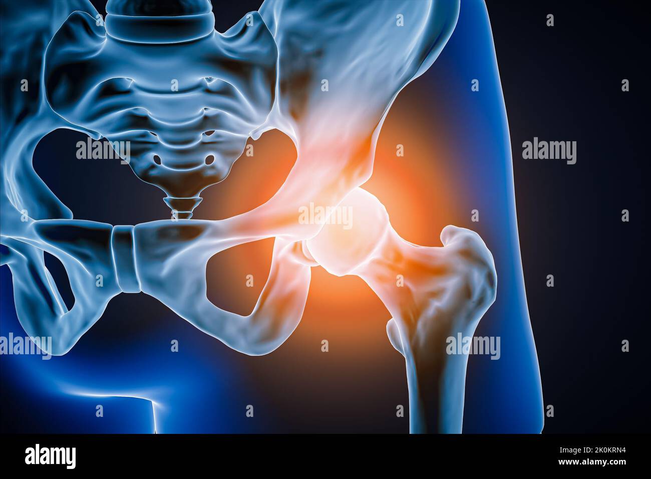 Vista anteriore o anteriore dell'articolazione dell'anca e delle ossa umane con infiammazione o lesione 3D illustrazione della rappresentazione. Patologia, dolore articolare, anatomia, osteolo Foto Stock