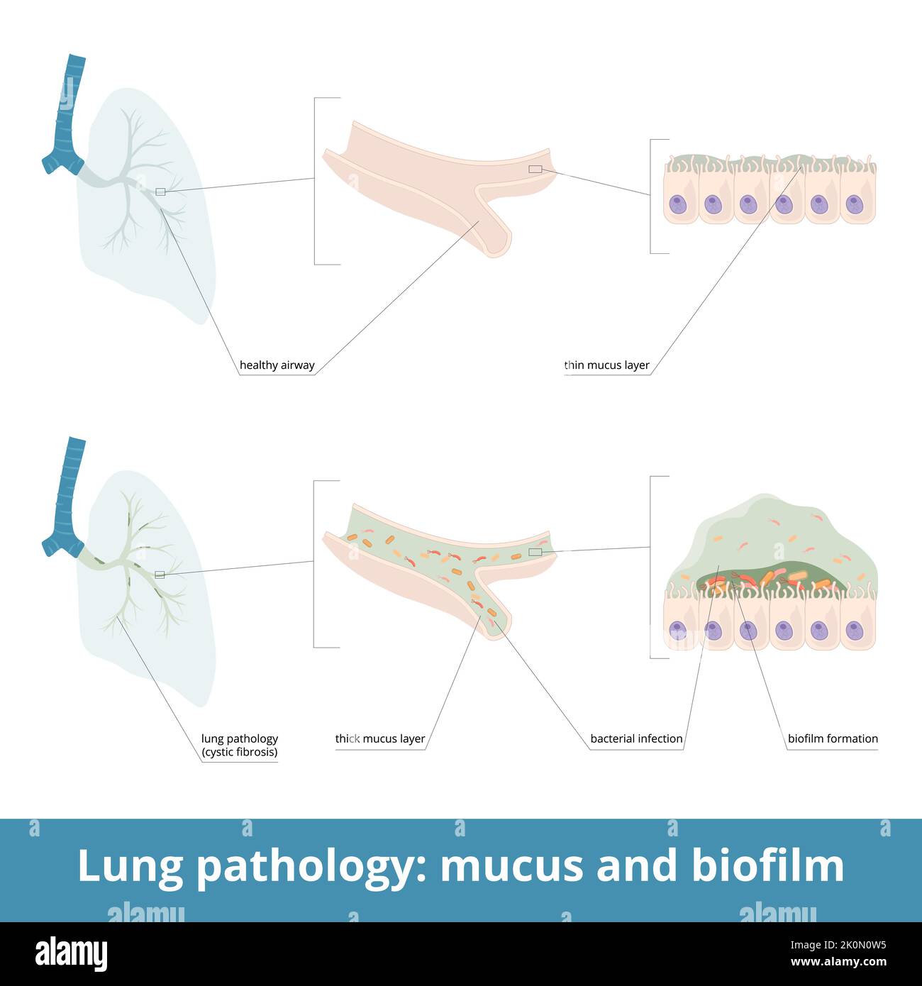 Patologie polmonari comuni e muco eccessivo. Le malattie (fibrosi cistica) possono causare la formazione di muco spesso nelle vie aeree. Formazione di biofilm. Illustrazione Vettoriale