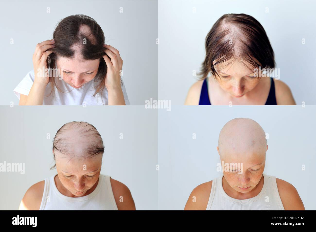 Fasi di calvizie femminile durante alopecia autoimmune. Calvizie durante la chemioterapia per il cancro Foto Stock