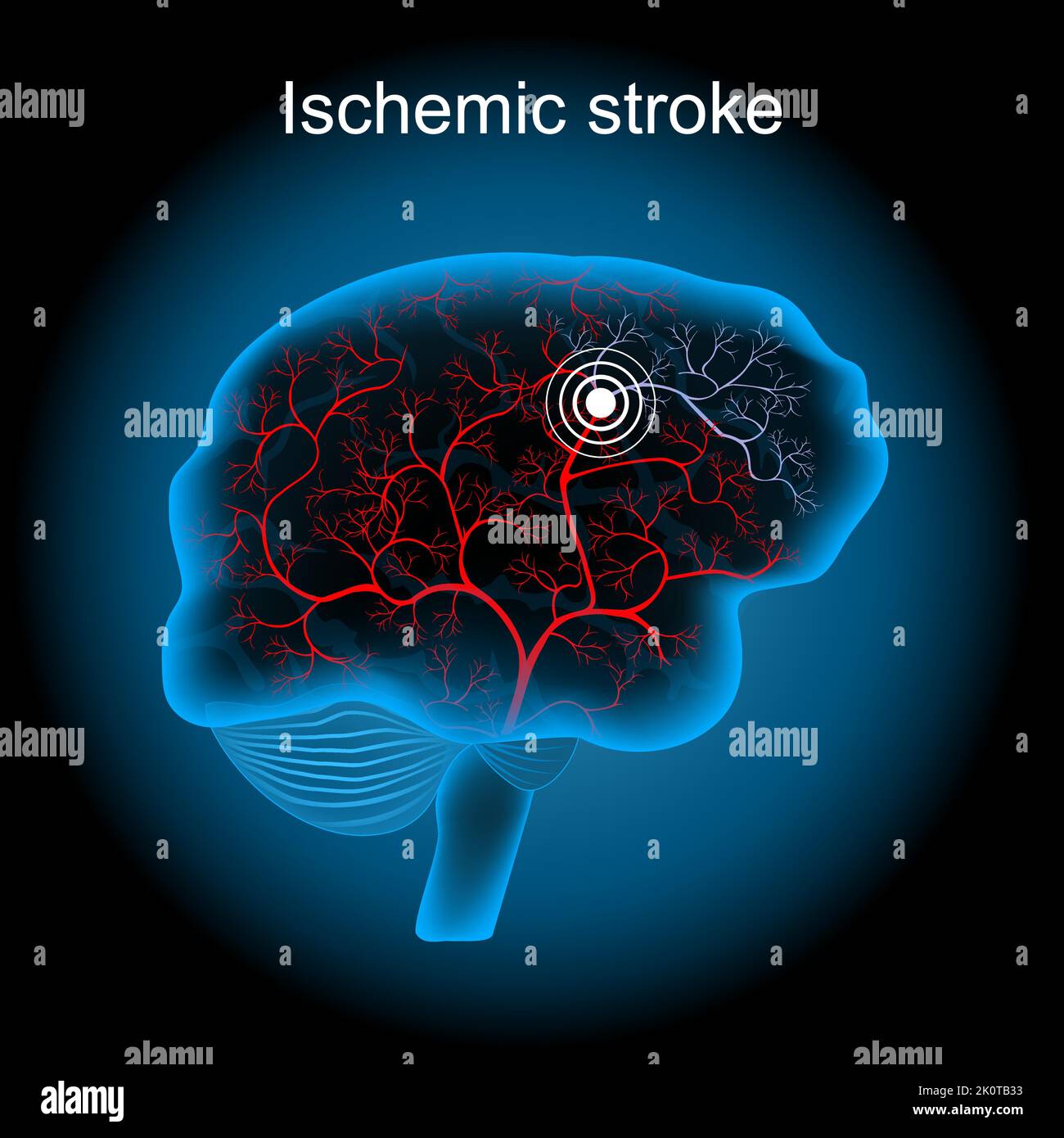 Infarto cerebrale. Ictus ischemico. Cervello umano con vaso sanguigno su sfondo scuro. Ischemia cerebrale causata da un coagulo di sangue in un'arteria risultante i Illustrazione Vettoriale