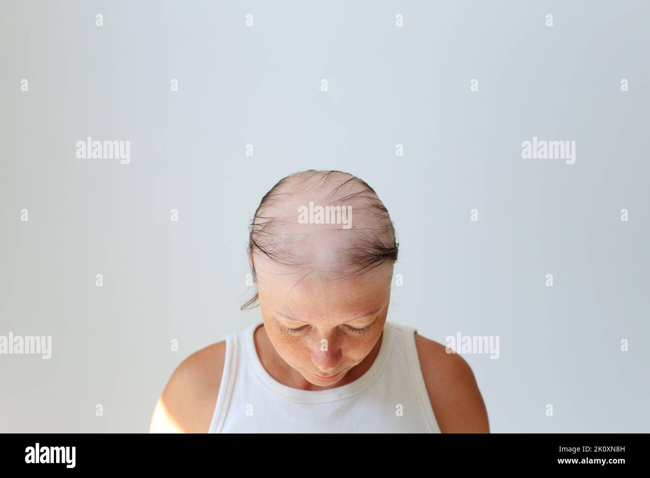 Perdita di capelli sotto forma di alopecia areata. Testa calva di una donna. Diradamento dei capelli dopo il covid. Cerotti calvo di alopecia totale Foto Stock