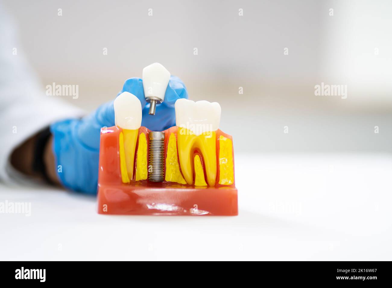 Tecnologia per impianti dentali e trattamento dei denti. Metallo corona Foto Stock