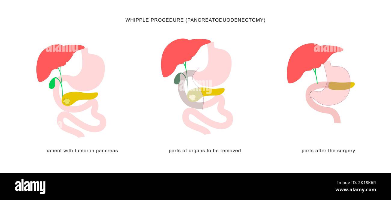 Infografica medica della procedura di whipple pancreaticoduodenectomia. Intervento chirurgico nel trattamento del cancro del pancreas. Illustrazione Vettoriale