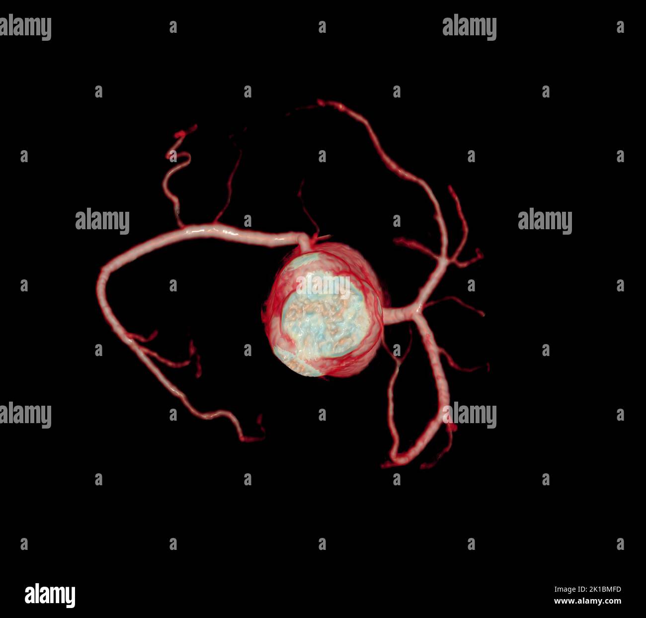 CT Cardiac 3D o CTA coronary Artery per la prevenzione delle malattie coronariche. Foto Stock