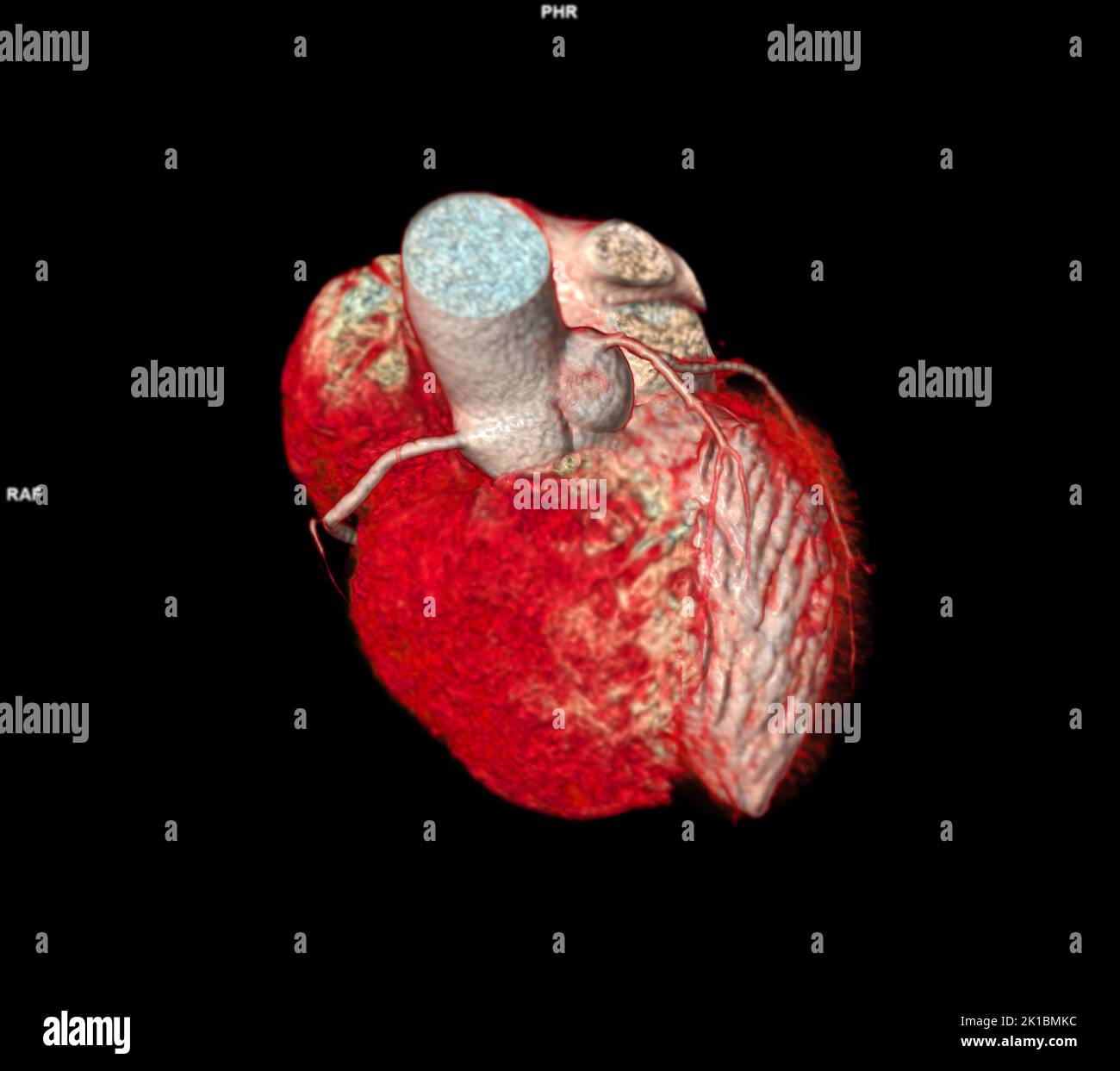 CT Cardiac 3D o CTA coronary Artery per la prevenzione delle malattie coronariche. Foto Stock