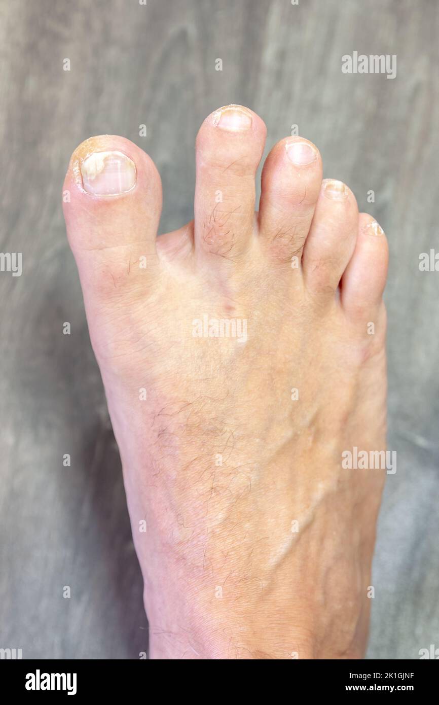 Una malattia dermatologica che colpisce le unghie causate da un fungo. Messa a fuoco selettiva con profondità di campo ridotta. Foto Stock