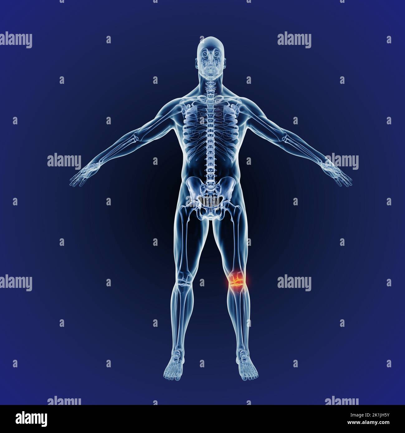 Quando l'infiammazione colpisce. Una rappresentazione cgi a tutta lunghezza del corpo umano indicante la struttura scheletrica. Foto Stock