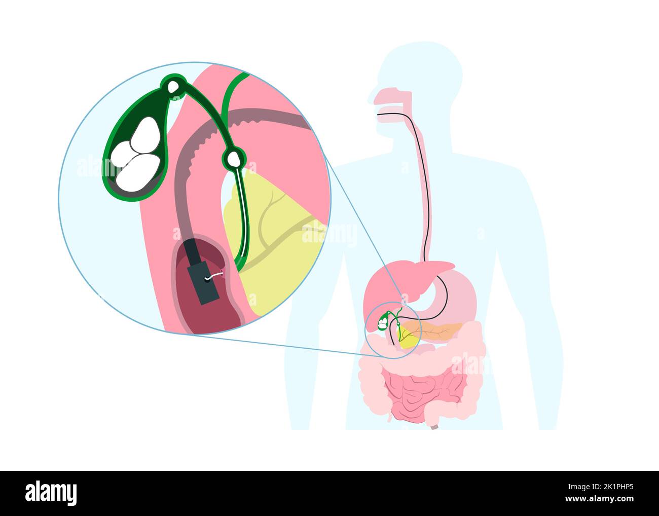 Rimozione endoscopica della pietra della cistifellea attraverso la bocca, lo stomaco, al dotto biliare. Infografiche delle operazioni mediche. Illustrazione Vettoriale