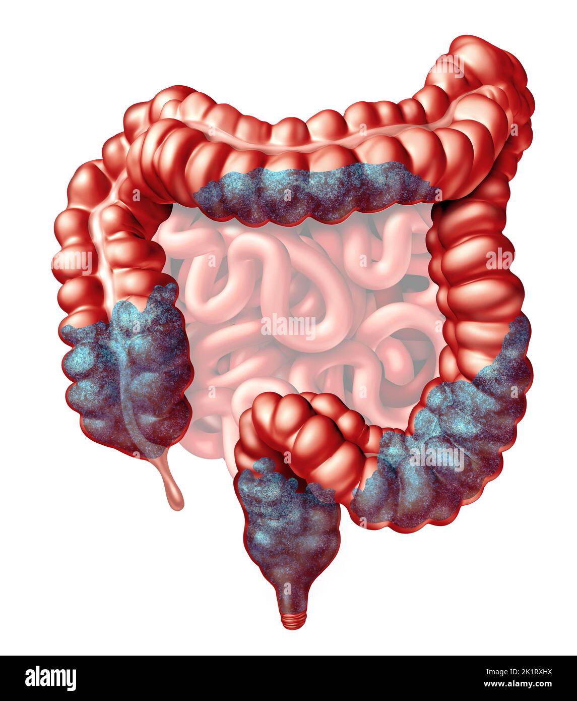 Costipazione anatomia e sintomi costipati come problema di movimento intestinale feci come un intestino e retto di un sistema digestivo come un gastrointestinale. Foto Stock