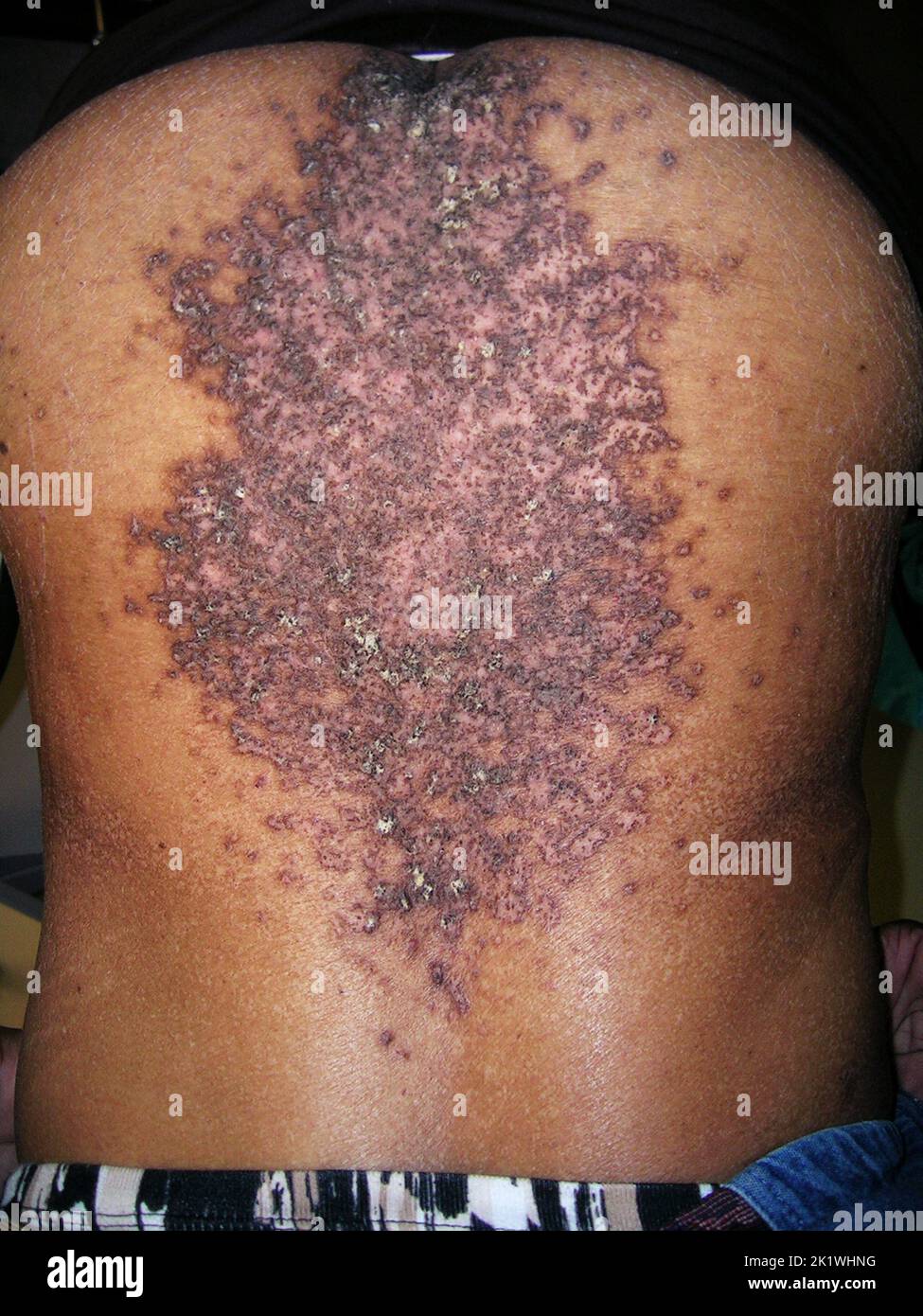 Malattia di Darier Foto Stock