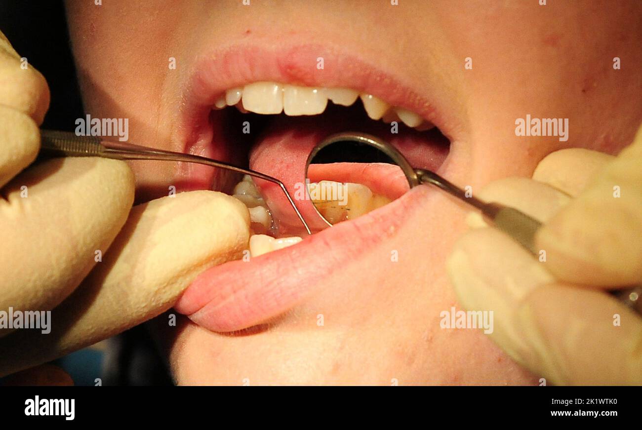 Foto del file datata 19/05/11 di una vista generale di un dentista al lavoro. Quasi un quarto della gente non è stato in grado di accedere alle cure da un dentista di NHS nell'ultimo anno, con un numero che si gira a 'odontoiatria DIY' di conseguenza, un nuovo sondaggio suggerisce. Data di emissione: Mercoledì 21 settembre 2022. Foto Stock