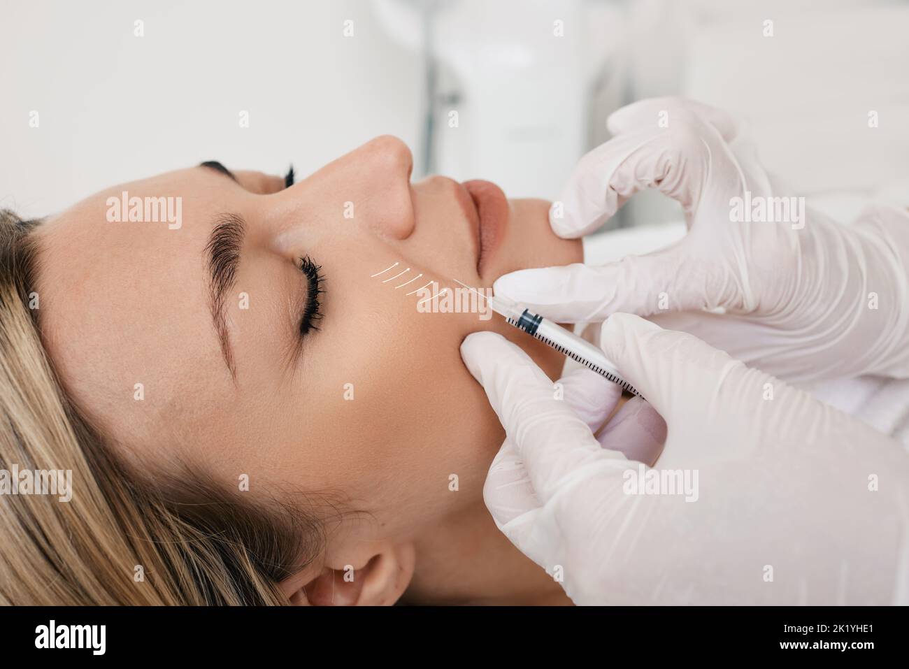 L'estetista che fa l'iniezione nelle pieghe nasolabiali alla paziente femmina. Correzione delle rughe sul viso della donna con riempitivi dermici Foto Stock