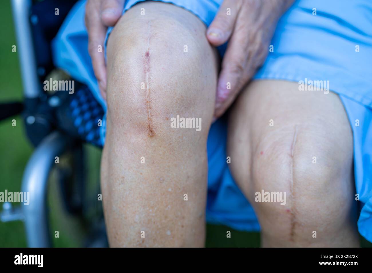 Asian anziano o anziano donna anziana paziente mostra le sue cicatrici chirurgico totale sostituzione articolazione ginocchio sutura ferita chirurgia artroplastica a letto in reparto ospedale infermieristico, sano forte concetto medico. Foto Stock