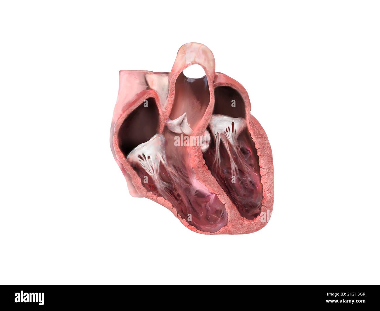 Anatomia del cuore, aneurisma ventricolare sinistro, rigonfiamento della parete, danno transmurale, si sviluppa aneurisma, dislocazione, formazione di aneurismi, paziente a rischio, rottura, trombo, embolia Foto Stock