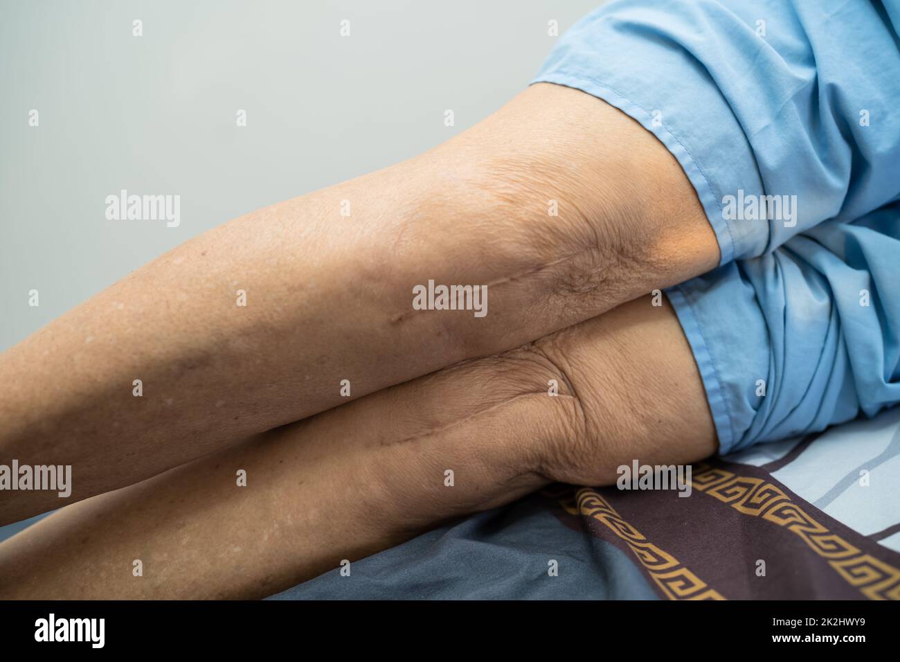 Asian anziano o anziano donna anziana paziente mostra le sue cicatrici chirurgico totale sostituzione articolazione ginocchio sutura ferita chirurgia artroplastica a letto in reparto ospedale infermieristico, sano forte concetto medico. Foto Stock