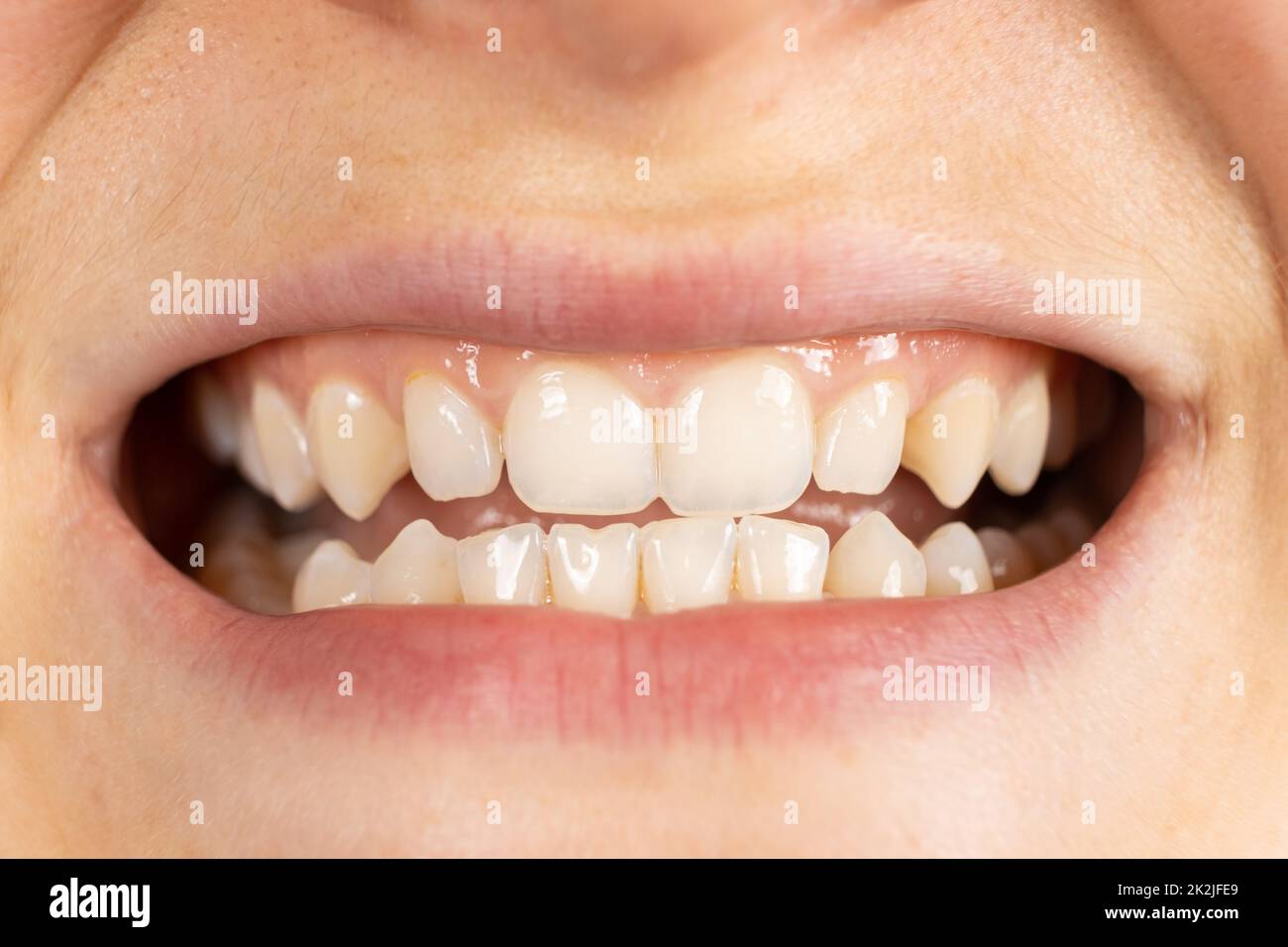 Paziente con malocclusione, spazio tra i denti superiore e inferiore, bocca ravvicinata. Foto Stock