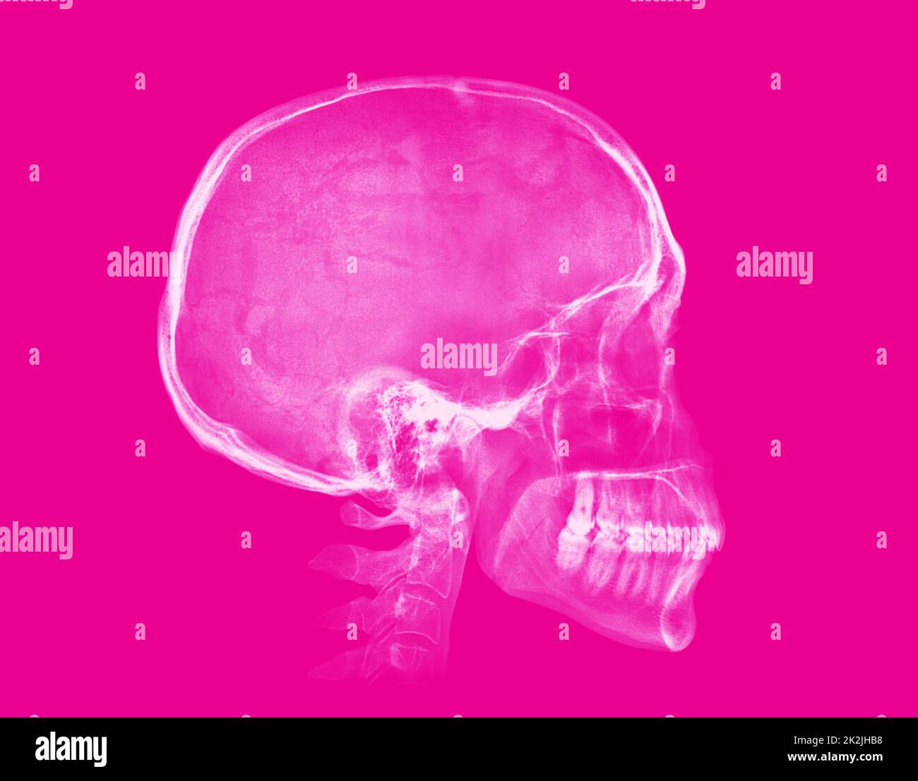 Cranio umano. Immagine radiografica su sfondo rosa Foto Stock