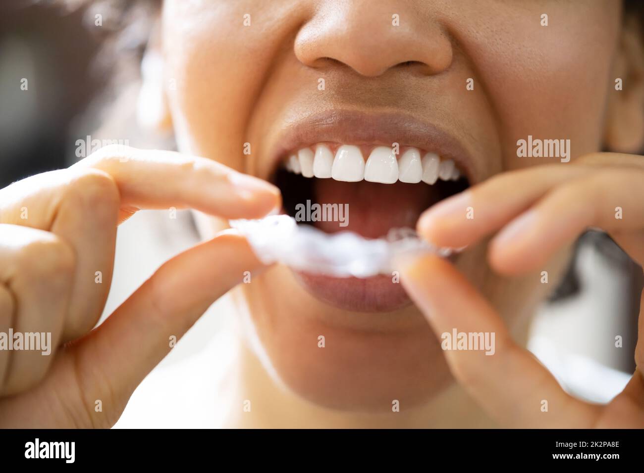 Guardia notturna dentale Aligner trasparente Foto Stock