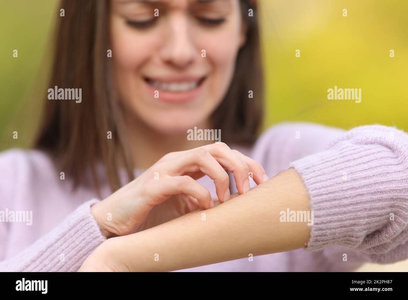 Stressato teen graffiante braccio itchy in un parco Foto Stock