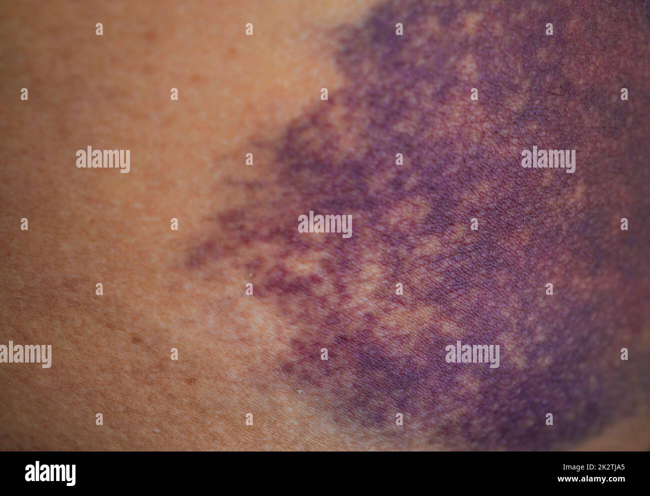 Lividi sulla pelle natiche lesioni da incidente a casa. Foto Stock