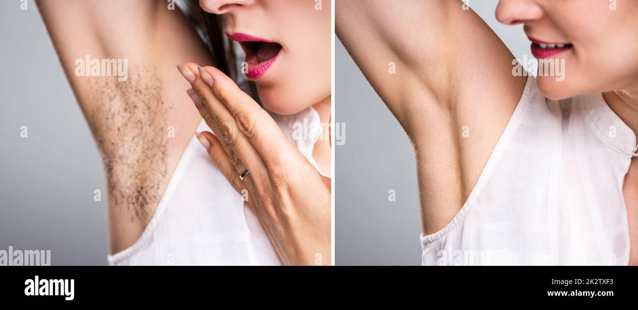 Prima e dopo il concetto di rimozione dei capelli del underarm Foto Stock