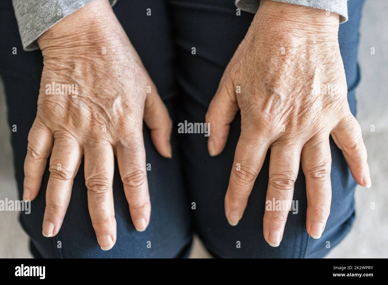 Donna anziana che soffre di artrite Foto Stock