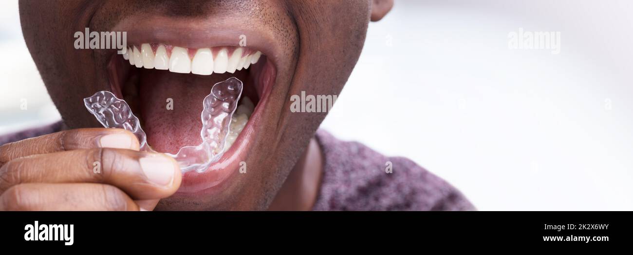 Uomo regolare gli allineatori trasparenti nei suoi denti Foto Stock