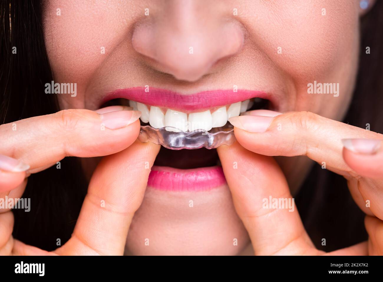 Donna mettendo allineatore trasparente in denti Foto Stock