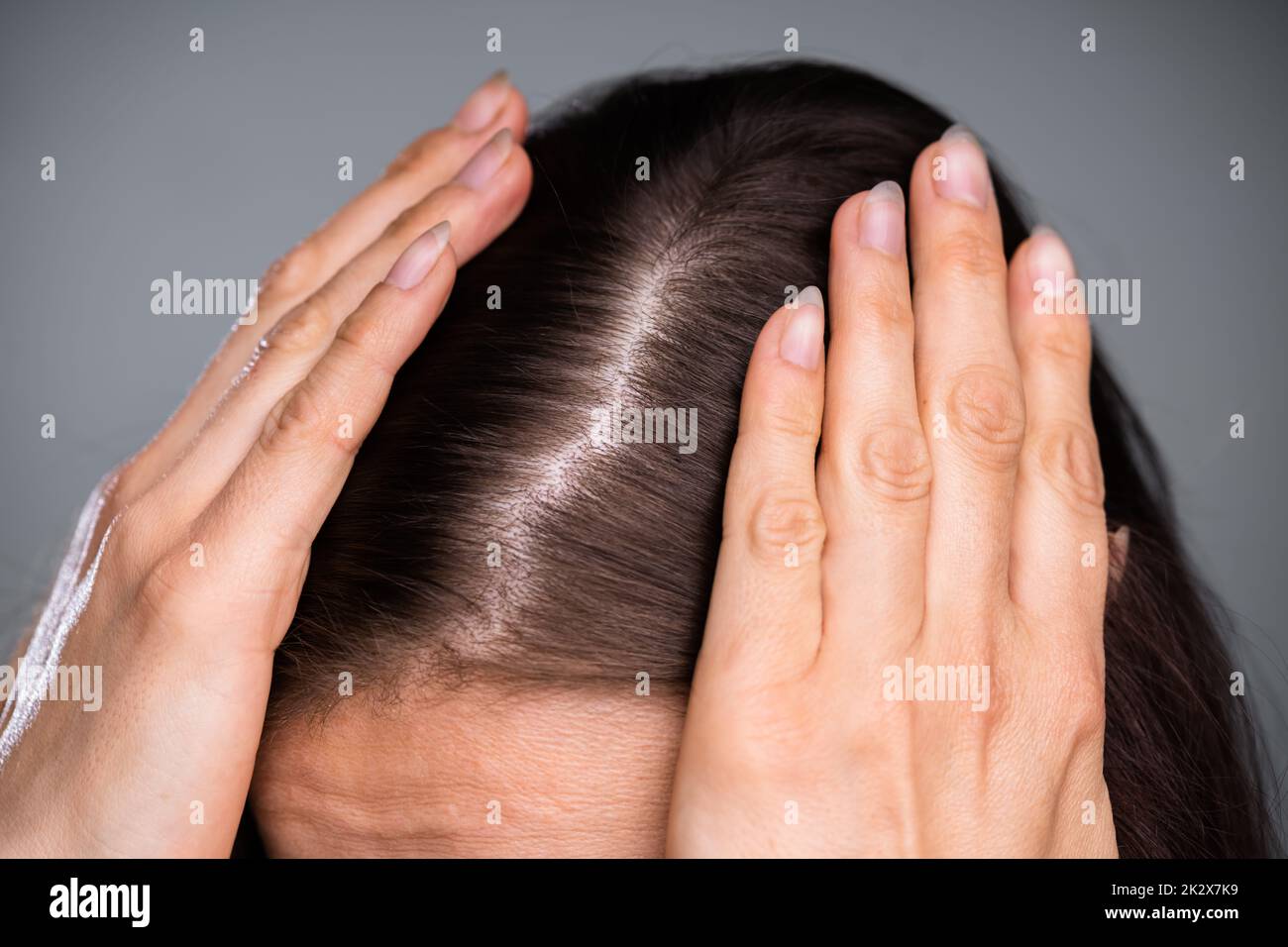 Donna con capelli assottigliati Foto Stock