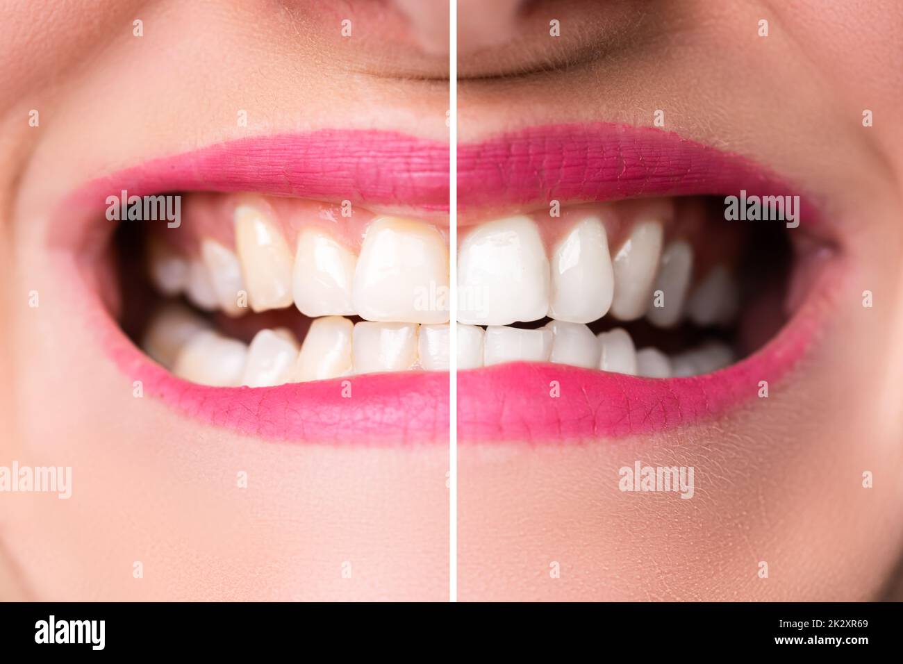 Denti della donna prima e dopo lo sbiancamento Foto Stock