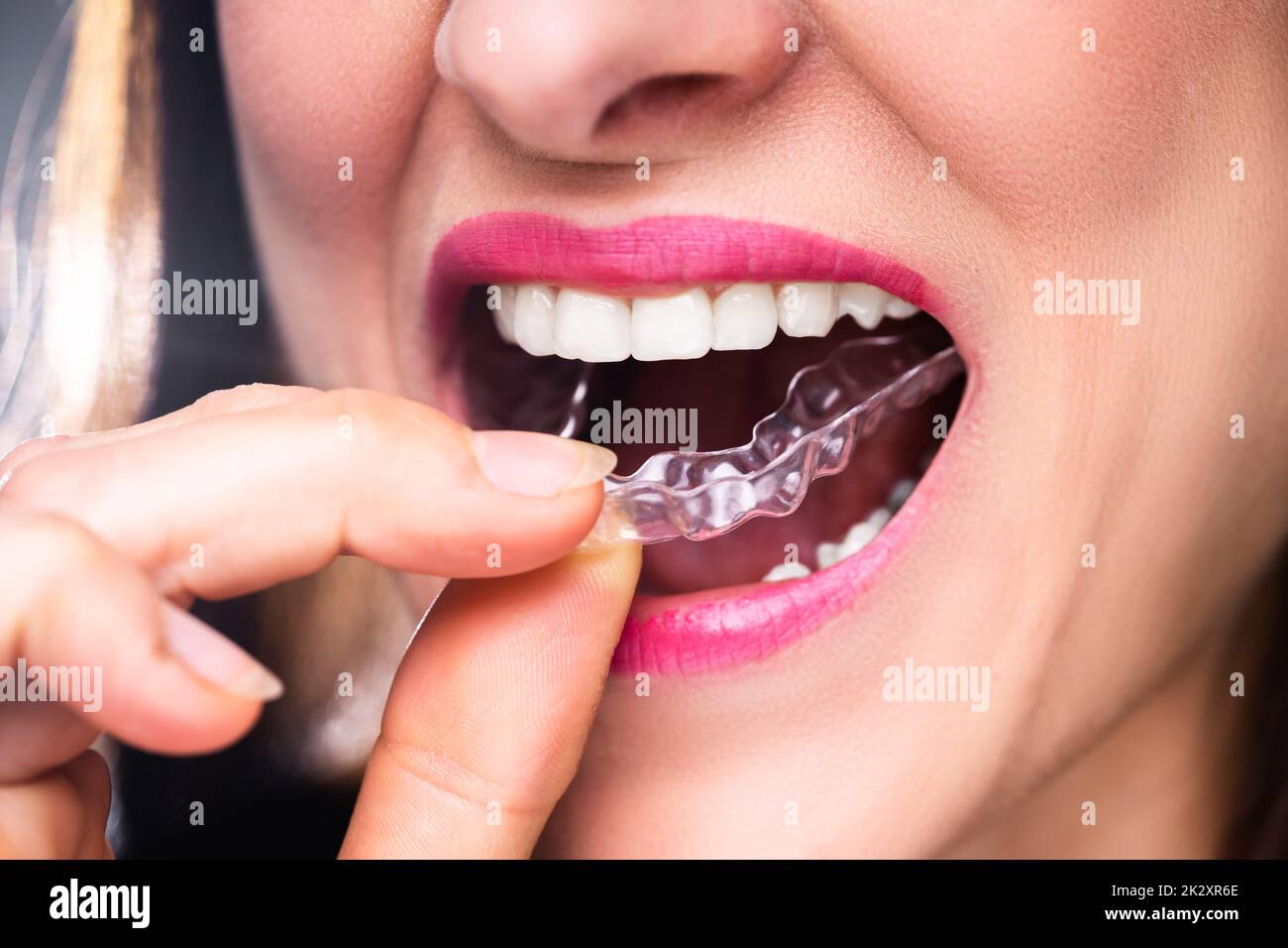 Donna mettendo allineatore trasparente in denti Foto Stock
