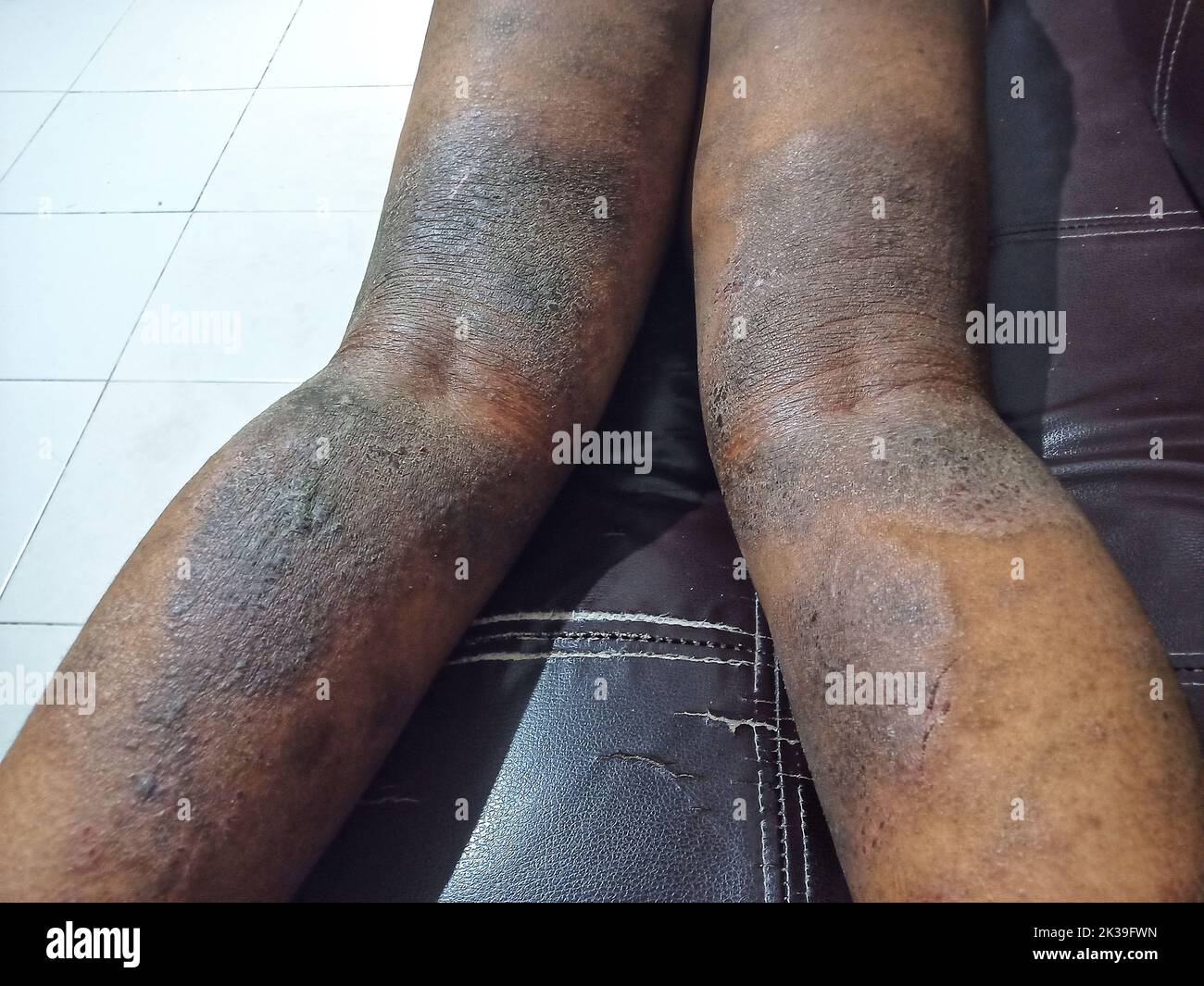 malattia della pelle causata da allergia alimentare,ecsima,allergia della pelle,cura della pelle,primo piano della pelle,prurito,prurito della pelle,problema della pelle,prurito della pelle Foto Stock