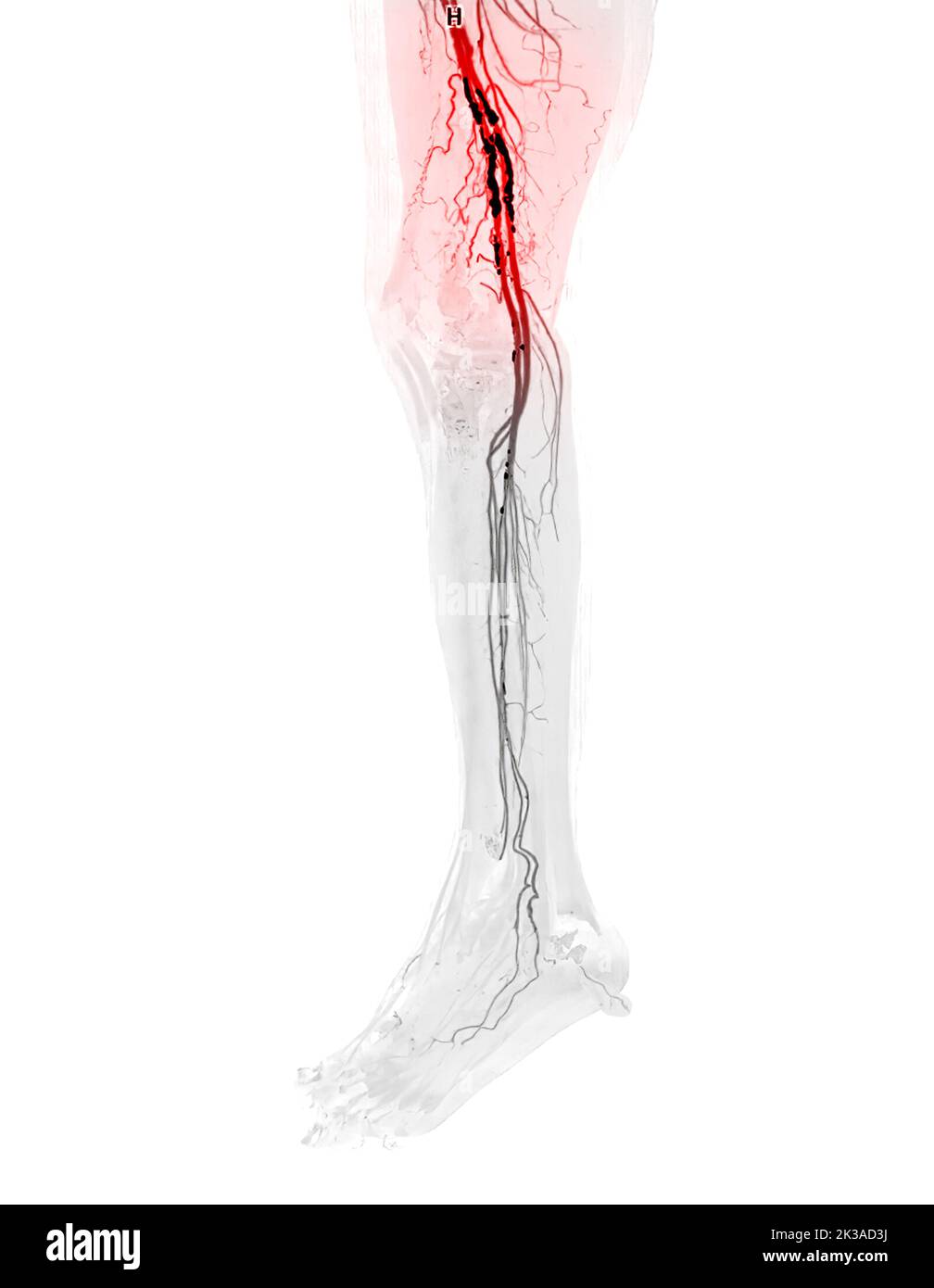 Immagine di scentratura dell'arteria femorale CTA dell'arteria femorale che presenta una malattia arteriosa periferica acuta o cronica. Foto Stock